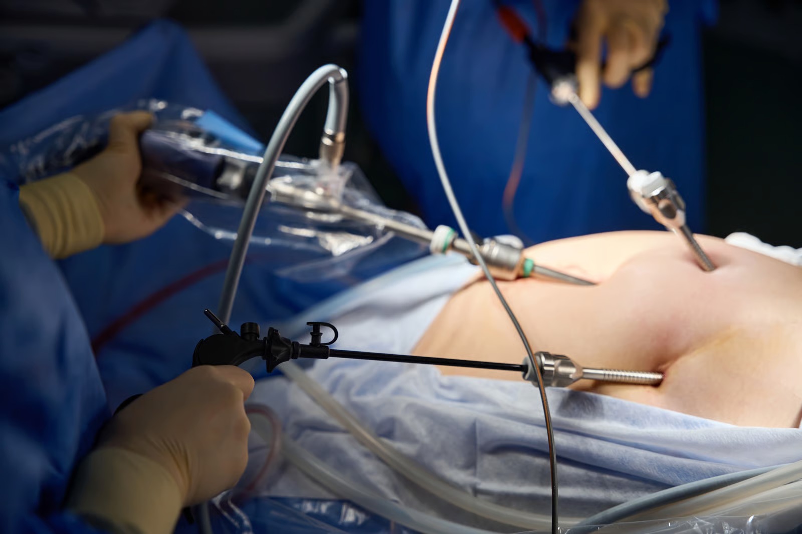 Surgeons operating through keyhole ports in the abdomen with a laparoscope and fine instruments at Kapadia Hospital, Mumbai